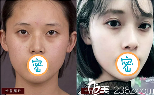 彭太平雙眼皮案例前后對(duì)比照 彭太平雙眼皮案例前后對(duì)比照