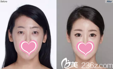 面部整形前后效果對比 面部整形前后效果對比