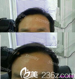 好開(kāi)心！韓國(guó)史丹利整形醫(yī)院李恩錫一個(gè)玻尿酸就讓老爸年輕了好幾歲