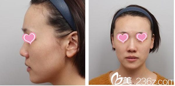 鼓起勇氣在韓國高諾鼻整形找鄭太英做的鼻子，效果杠杠的