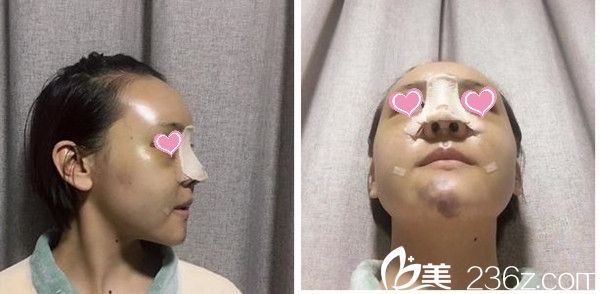 術(shù)后第5天 術(shù)后第5天