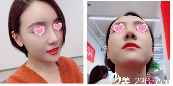 術(shù)后一個(gè)月效果 術(shù)后一個(gè)月效果