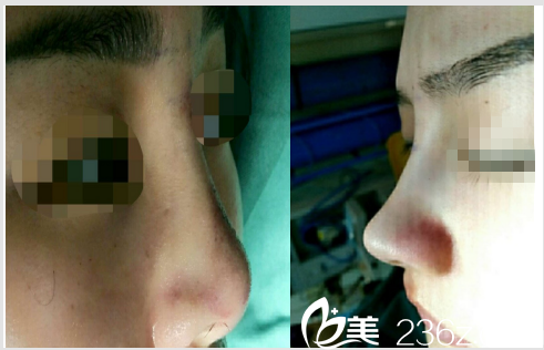 術(shù)后即刻照片