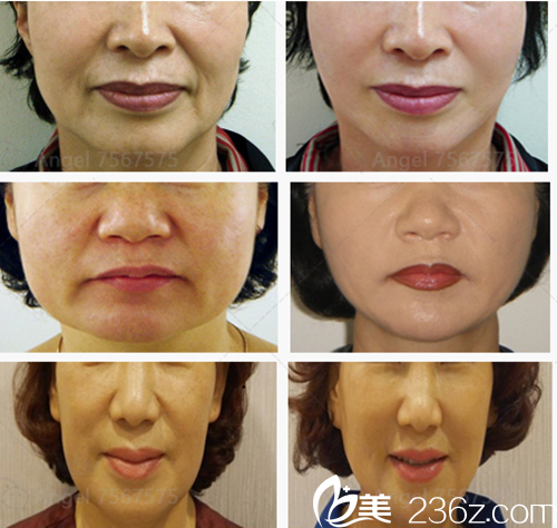 韓國濟(jì)州島天使女性綜合醫(yī)院美容整形埋線提升案例 韓國濟(jì)州島天使女性綜合醫(yī)院美容整形埋線提升案例