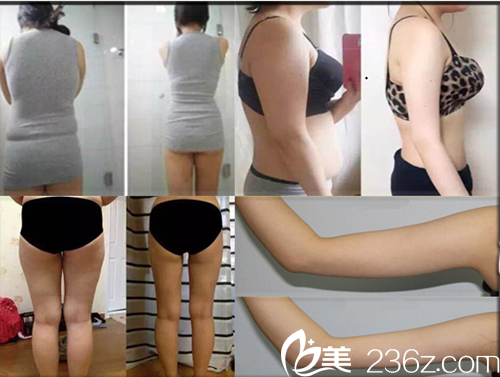 韓國濟(jì)州島天使女性綜合醫(yī)院美容整形溶脂瘦身案例 韓國濟(jì)州島天使女性綜合醫(yī)院美容整形溶脂瘦身案例