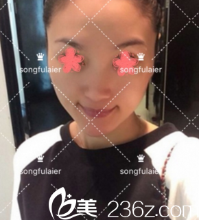 鼻綜合術(shù)前 鼻綜合術(shù)前