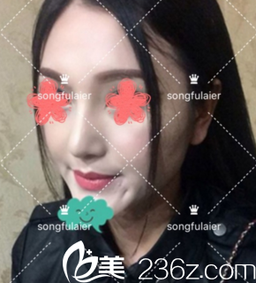 鼻綜合術(shù)后半個(gè)月 鼻綜合術(shù)后半個(gè)月