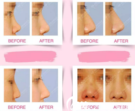 世賢整形外科鼻部修復(fù)案例