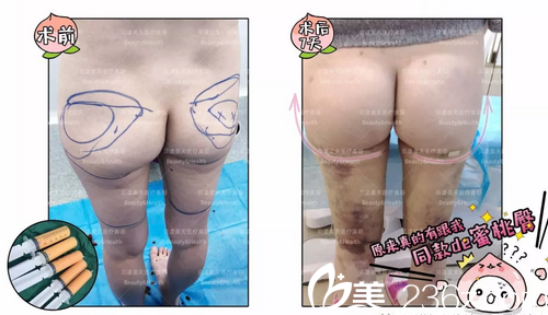 深圳貝漾美天董磊自體脂肪豐臀案例對比圖 深圳貝漾美天董磊自體脂肪豐臀案例對比圖