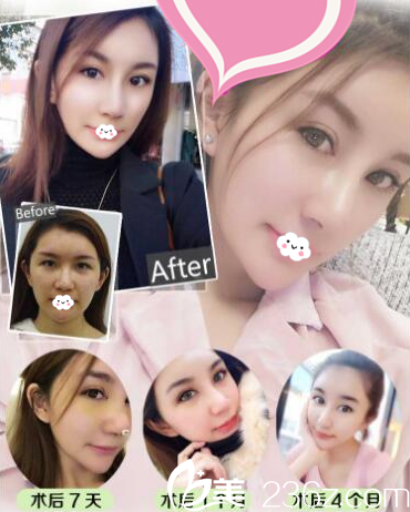  深圳貝漾美天曹思佳做的雙眼皮和隆鼻案例