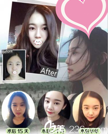  深圳貝漾美天曹思佳貝塞爾無痕雙眼皮案例術(shù)后半年效果圖