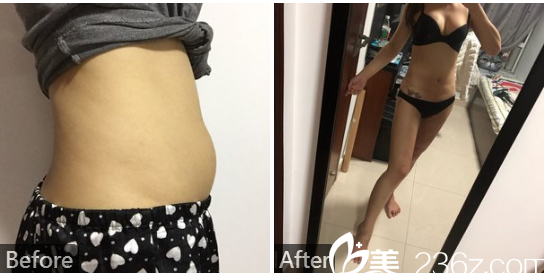 深圳貝漾美天胡佰春醫(yī)生腰腹部抽脂案例