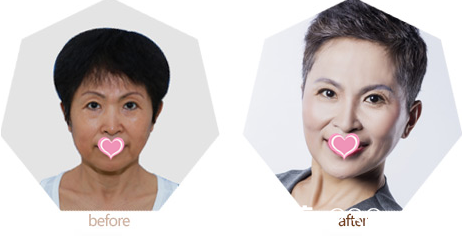 北京上上相整形美容醫(yī)院面部精雕案例 北京上上相整形美容醫(yī)院面部精雕案例