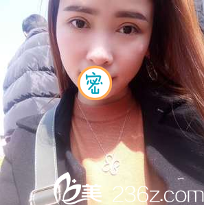 找綿陽(yáng)茗匯肖剛醫(yī)生做了切開(kāi)雙眼皮+開(kāi)眼角手術(shù) 我也是大眼女神啦