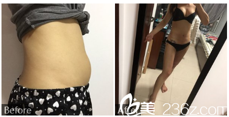 深圳貝漾美馮衛(wèi)醫(yī)生大腿及腰腹部抽脂案例 深圳貝漾美馮衛(wèi)醫(yī)生大腿及腰腹部抽脂案例