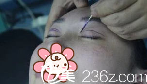 金沅碩院長給我手術(shù)中