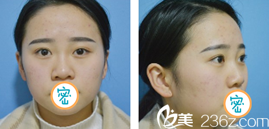 達(dá)州雙均玻尿酸隆鼻術(shù)前照 達(dá)州雙均玻尿酸隆鼻術(shù)前照