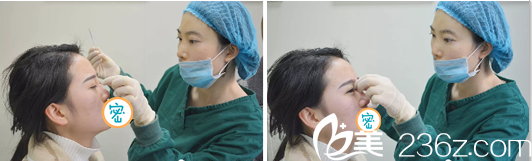 達(dá)州雙均李易蔓注射玻尿酸隆鼻 達(dá)州雙均李易蔓注射玻尿酸隆鼻