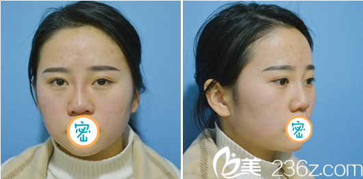 李易蔓玻尿酸隆鼻術(shù)后即刻效果 李易蔓玻尿酸隆鼻術(shù)后即刻效果