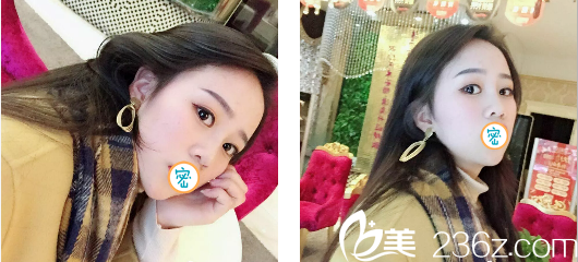 玻尿酸隆鼻+瘦臉術(shù)后7天效果 玻尿酸隆鼻+瘦臉術(shù)后7天效果