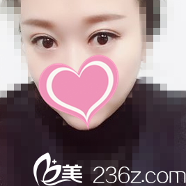 在韓國世賢整形醫(yī)院做了雙眼皮修復(fù)后解決了我的大小眼，讓我找回自信！