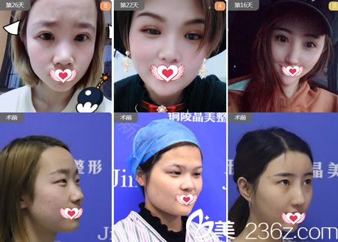 銅陵晶美整形美容醫(yī)院朱博眼部整形案例對(duì)比圖