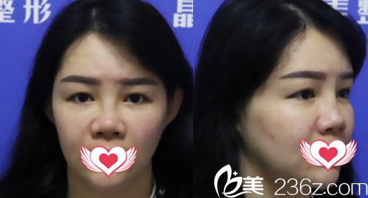 在美容院做注射隆鼻失敗案例照片 在美容院做注射隆鼻失敗案例照片