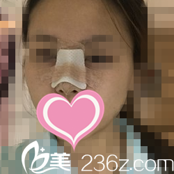 鼻整形術后第五天狀況