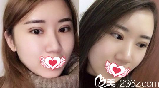 找合肥壹加壹整形外科醫(yī)院甘泉涌割雙眼皮第3天恢復(fù)情況圖