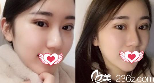 合肥壹加壹整形美容醫(yī)院甘泉涌全切雙眼皮整形案例術(shù)后第6天拆線后樣子