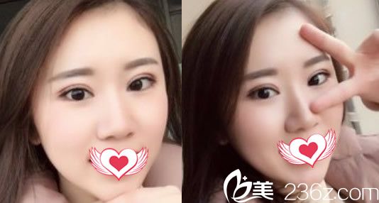 去合肥壹加壹整形美容醫(yī)院割雙眼皮術(shù)后第9天效果展示