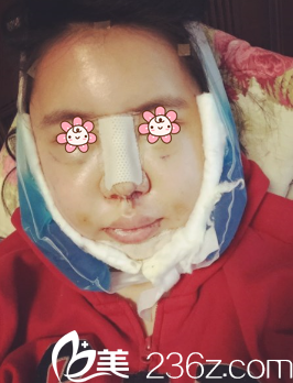 <!--<i data=20240703-sp></i>-->面部吸脂術后3天 <!--<i data=20240703-sp></i>-->面部吸脂術后3天