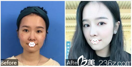 汕頭曙光殷運(yùn)成醫(yī)生鼻綜合隆鼻案例對比圖