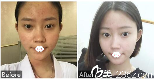 汕頭曙光梁威杰做的黃金微針祛痘案例