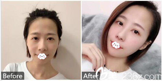 汕頭曙光醫(yī)生高定新鼻綜合隆鼻案例