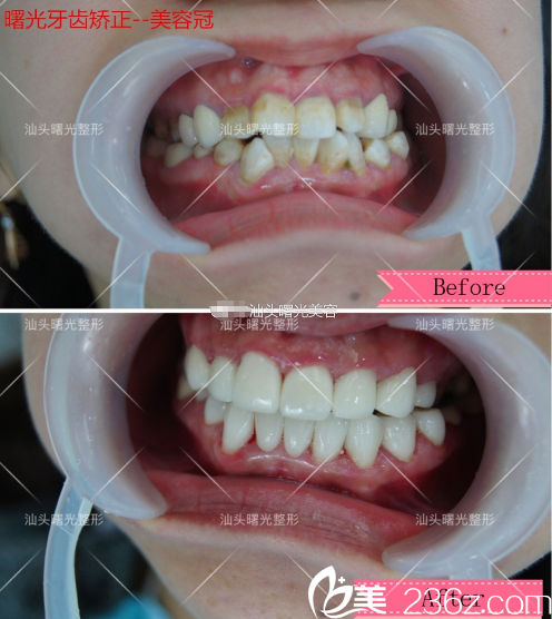 汕頭曙光龐觀養(yǎng)做的美容冠牙齒矯正案例