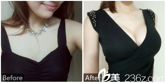 汕頭曙光殷運(yùn)成院長(zhǎng)假體隆胸案例 汕頭曙光殷運(yùn)成院長(zhǎng)假體隆胸案例
