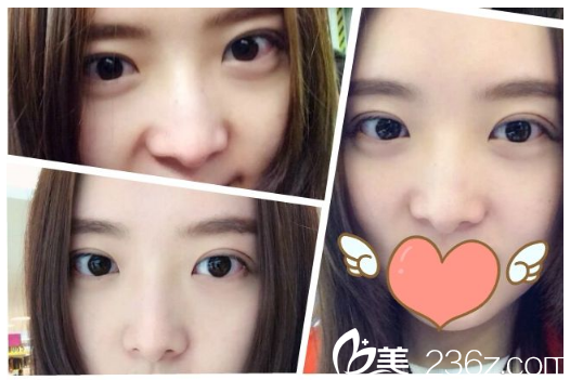 深圳北大醫(yī)院李天石醫(yī)生雙眼皮