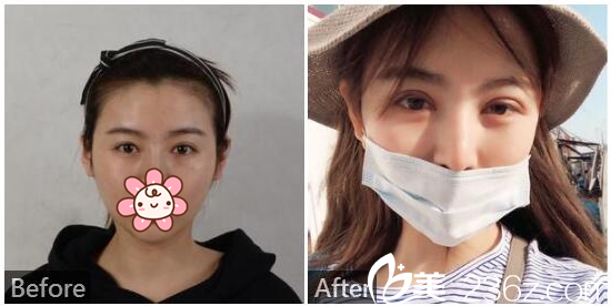 深圳北大醫(yī)院做的切開雙眼皮