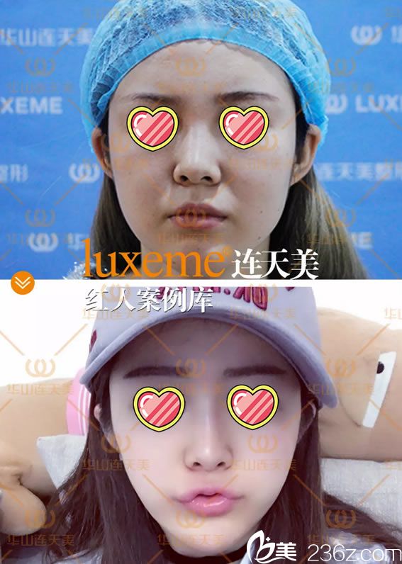 連天美玻尿酸填充<span style=