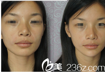 注射法令紋、豐下巴案例