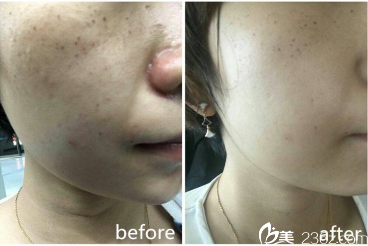 光子嫩膚治療案例 光子嫩膚治療案例