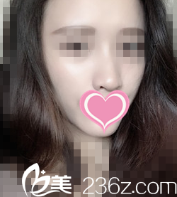 在韓國世民整形醫(yī)院做自體脂肪填充全臉后不僅年輕十歲，還成功晉升為女神