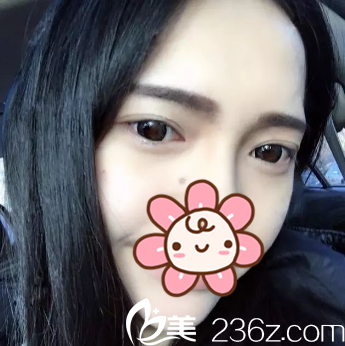 <!--<i data=20240703-sp></i>-->院長給我去完眼袋半個月了