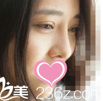 術(shù)后2個(gè)月