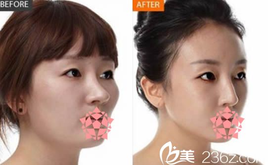 鼻綜合隆鼻前后對比<span style= 鼻綜合隆鼻前后對比<span style=