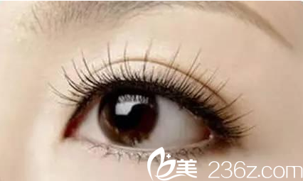 雙眼皮整形手術(shù)