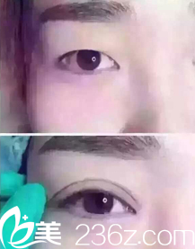 雙眼皮整形前后效果對比
