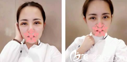 做完雙眼皮7天拆線后的圖片 做完雙眼皮7天拆線后的圖片