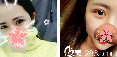 給親們分享我讓廈門金貴香醫(yī)生做切開雙眼皮的15天效果，真是超自然！